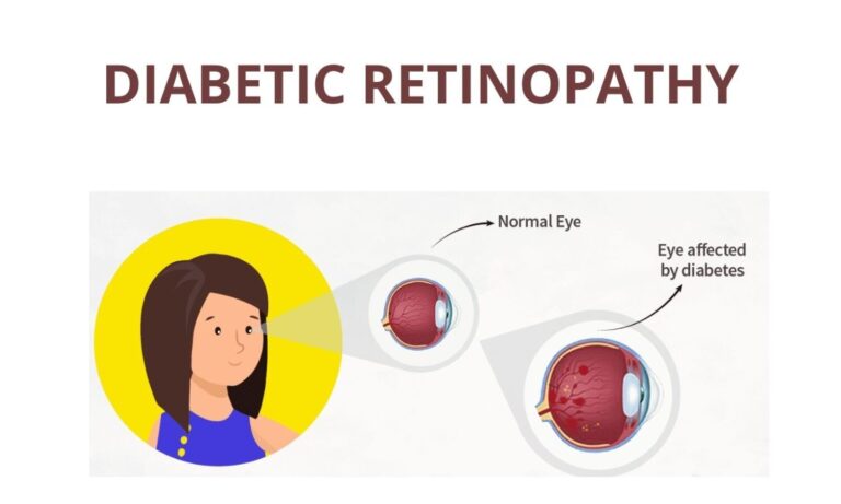 If You are Looking for the Treatment of Diabetic Retinopathy in India, then Look Here.