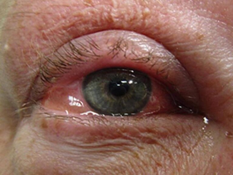 Visit Here for Getting the Best Treatment of Allergy of Eyes in India.