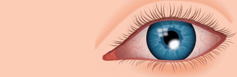 Retinitis Pigmentosa Cure in Ayurveda