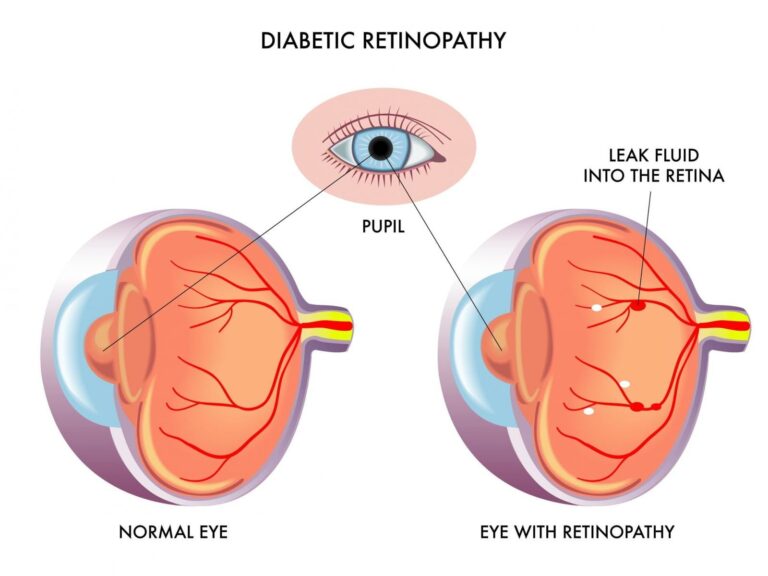 Is There Any Way To Cure Diabetic Retinopathy Without Laser And Injection?