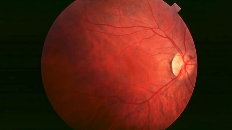 Latest Retinitis Pigmentosa Treatment Available Now in India