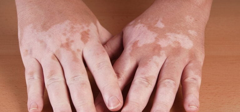 Leucoderma Healing with Ayurvedic Skin Pigment Care