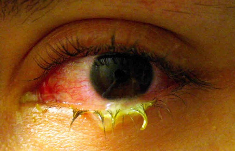 Ayurvedic Treatment of Conjunctivitis in India