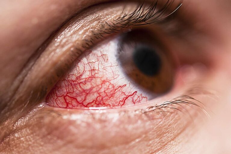 What are the different causes and symptoms of Uveitis?