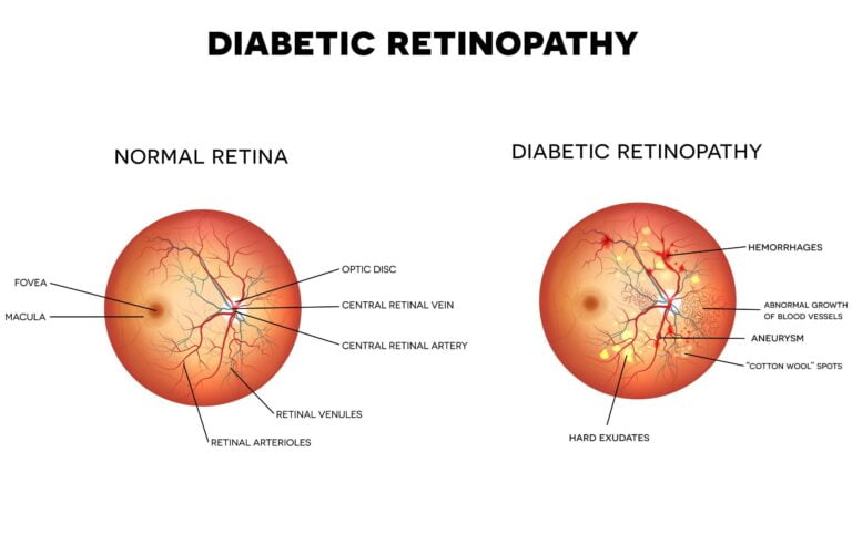 Searching for a cure of Diabetic retinopathy in India? Ayurveda is the way to go!