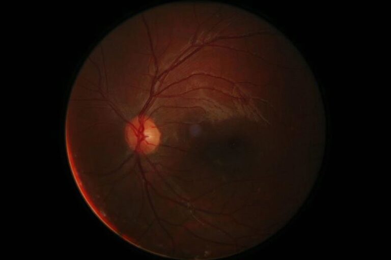 Treatment of Retinitis Pigmentosa With Ayurveda