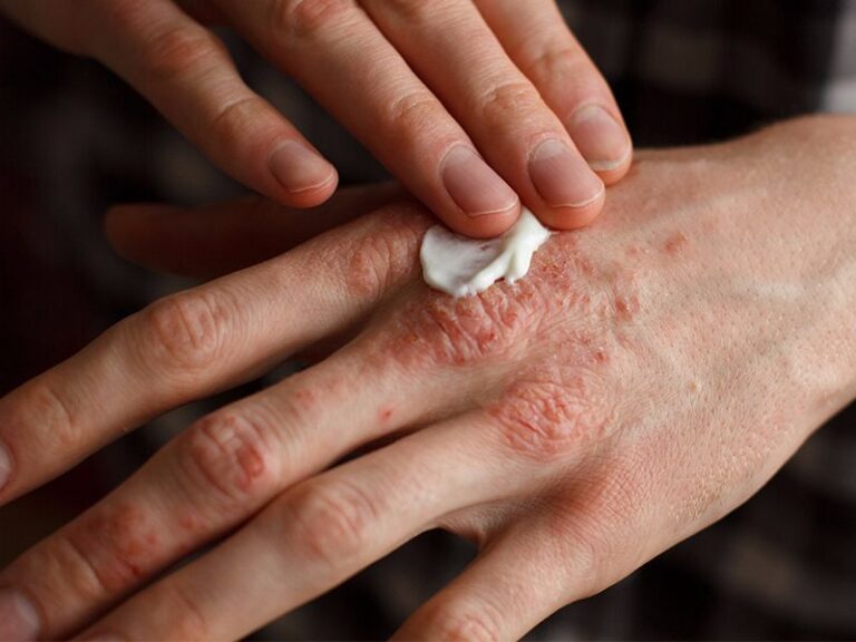 Ayurvedic Treatment of Eczema in India