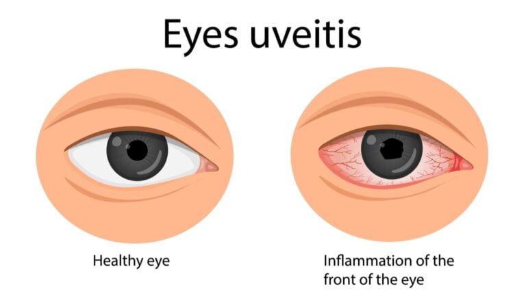 Treatment for Uveitis of the eye in India now possible by Ayurveda