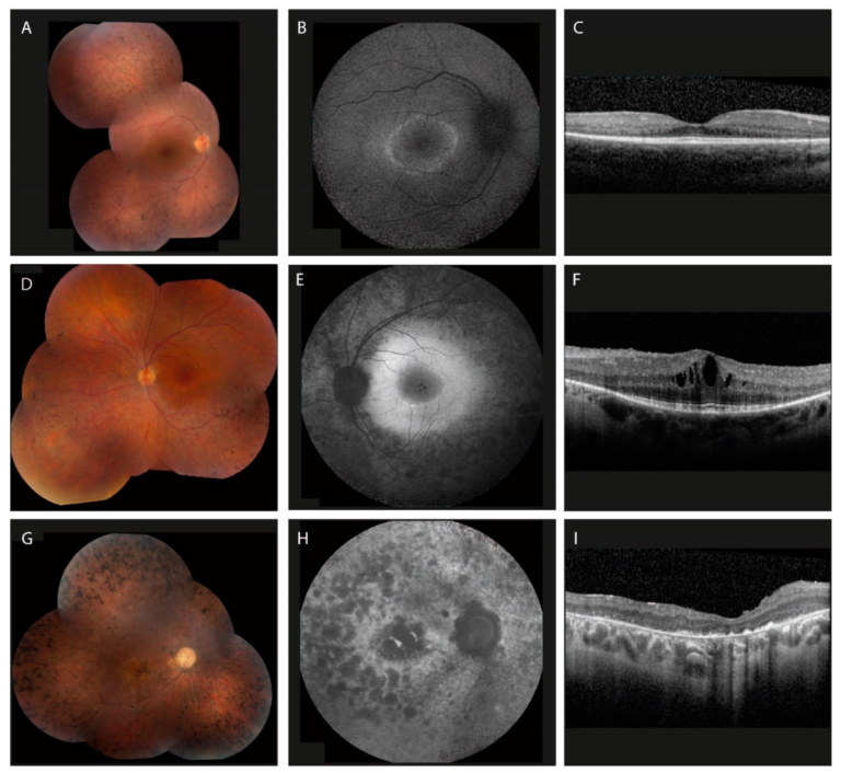 Retinitis Pigmentosa Treatment in India