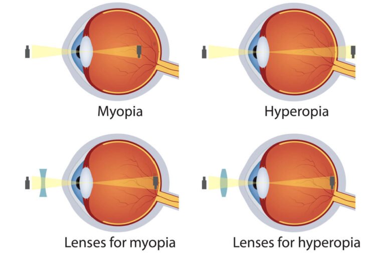 If You are Looking for the Best in Class Ayurvedic Treatment of Myopia in India, Then Click Here.