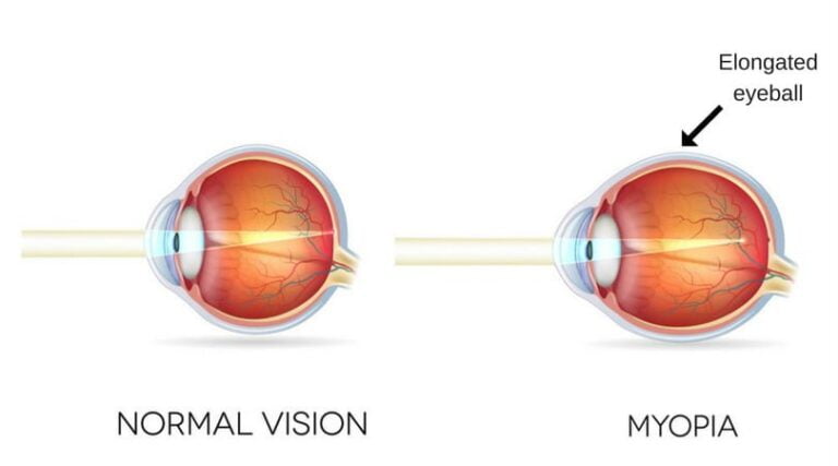 Ayurvedic Treatment of Myopia in India