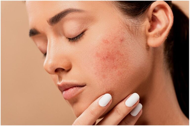 Skin Care with Ayurveda in Hot Summers.