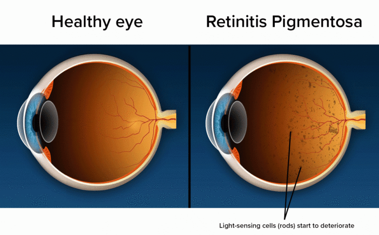 Retinitis Pigmentosa treatment in India