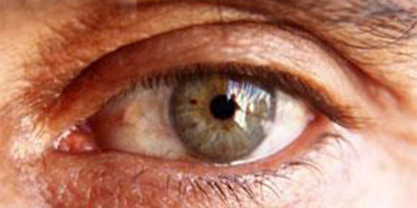 Redness and Watering in a dry eye