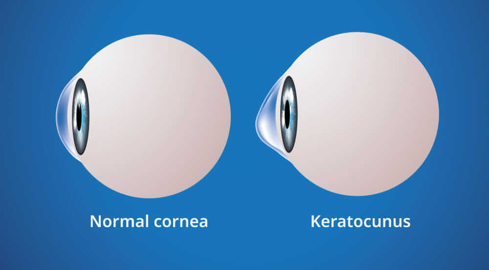 Ayurvedic Keratoconus Treatment in India