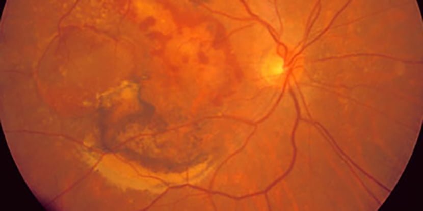 About Macular Degeneration