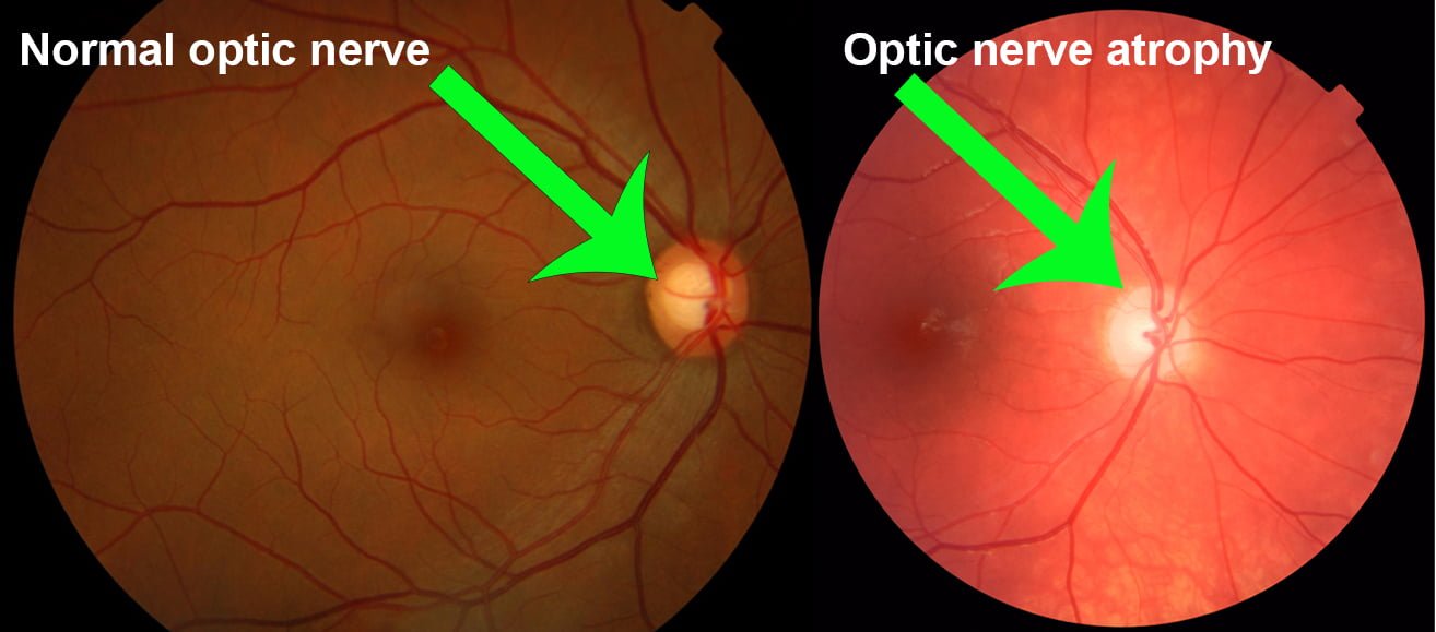 About Optic Nerve Atrophy