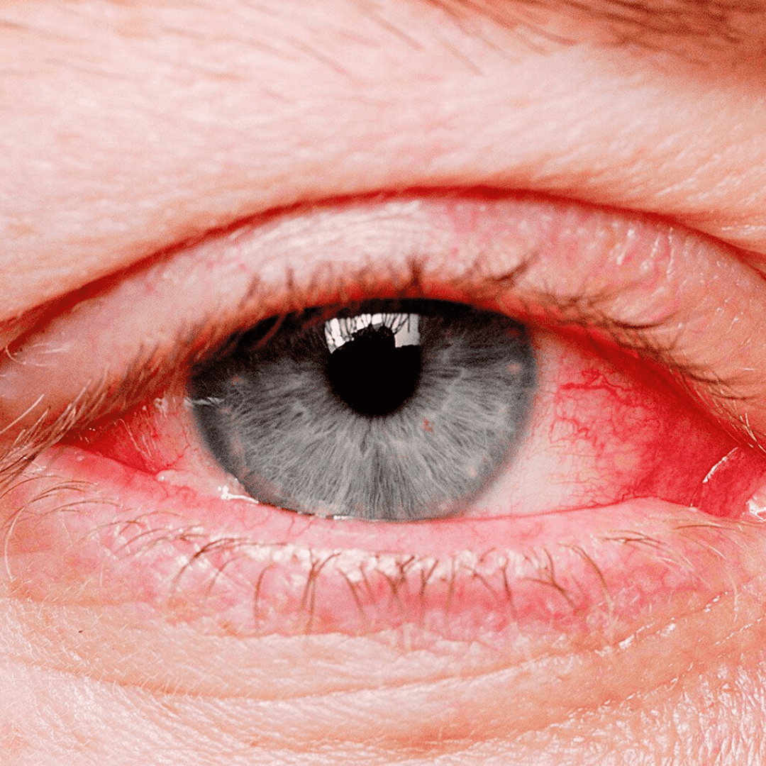 Conjunctivitis Redness in Eyes