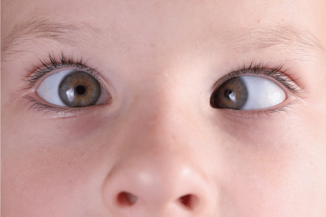 About Squint Strabismus