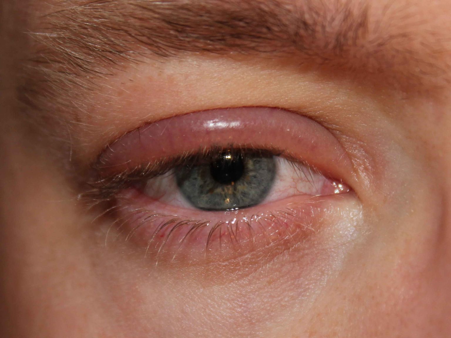 Swelling in the eyes