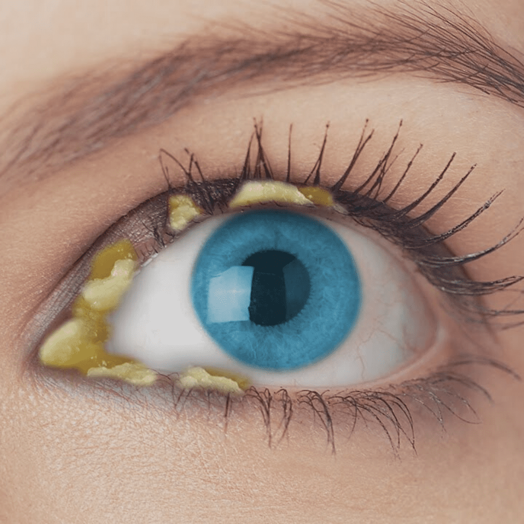 Oily Particles on Eyelashes