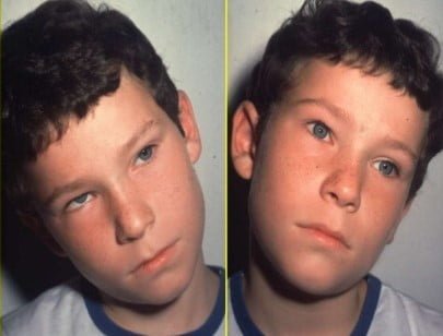 Tilting of the neck in Amblyopia