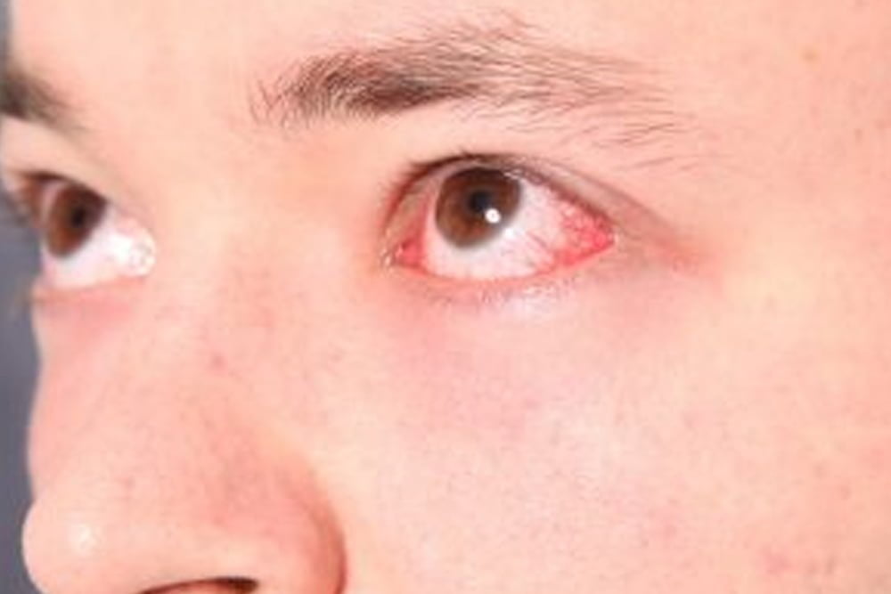 Allergic conjunctivitis or eye allergy