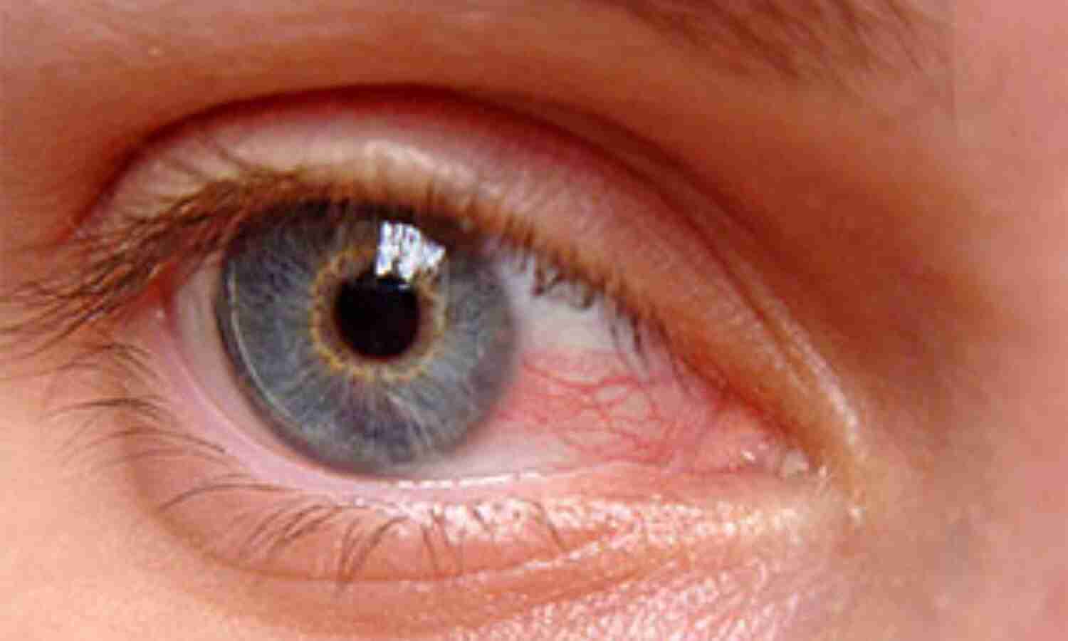 What is Pterygium?