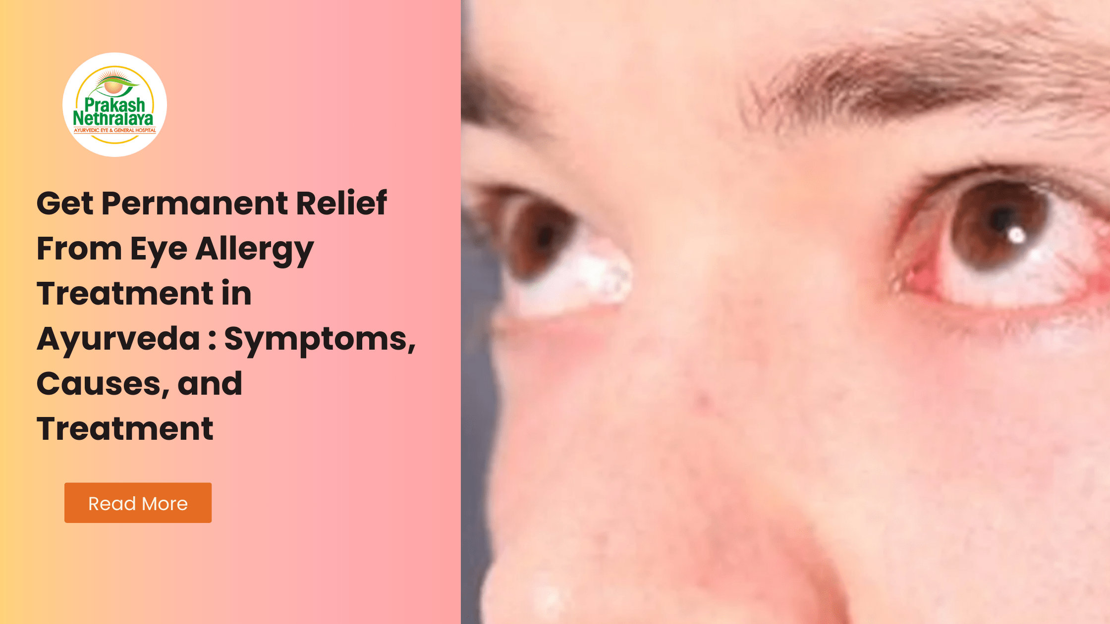 Ayurvedic treatment for eye allergy