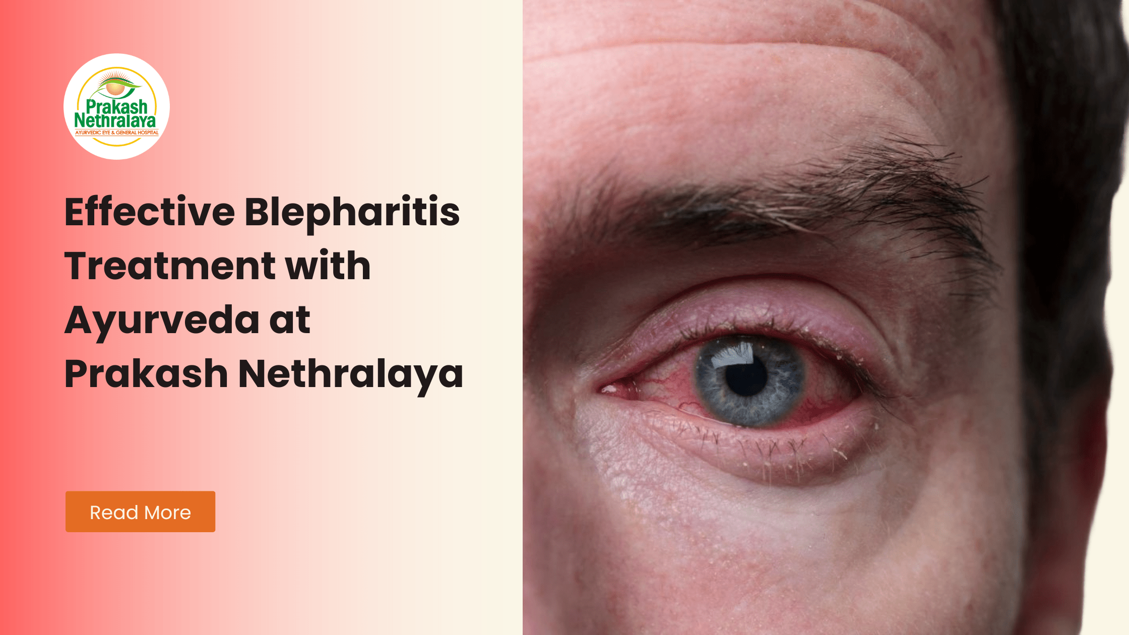 Blepharitis Treatment