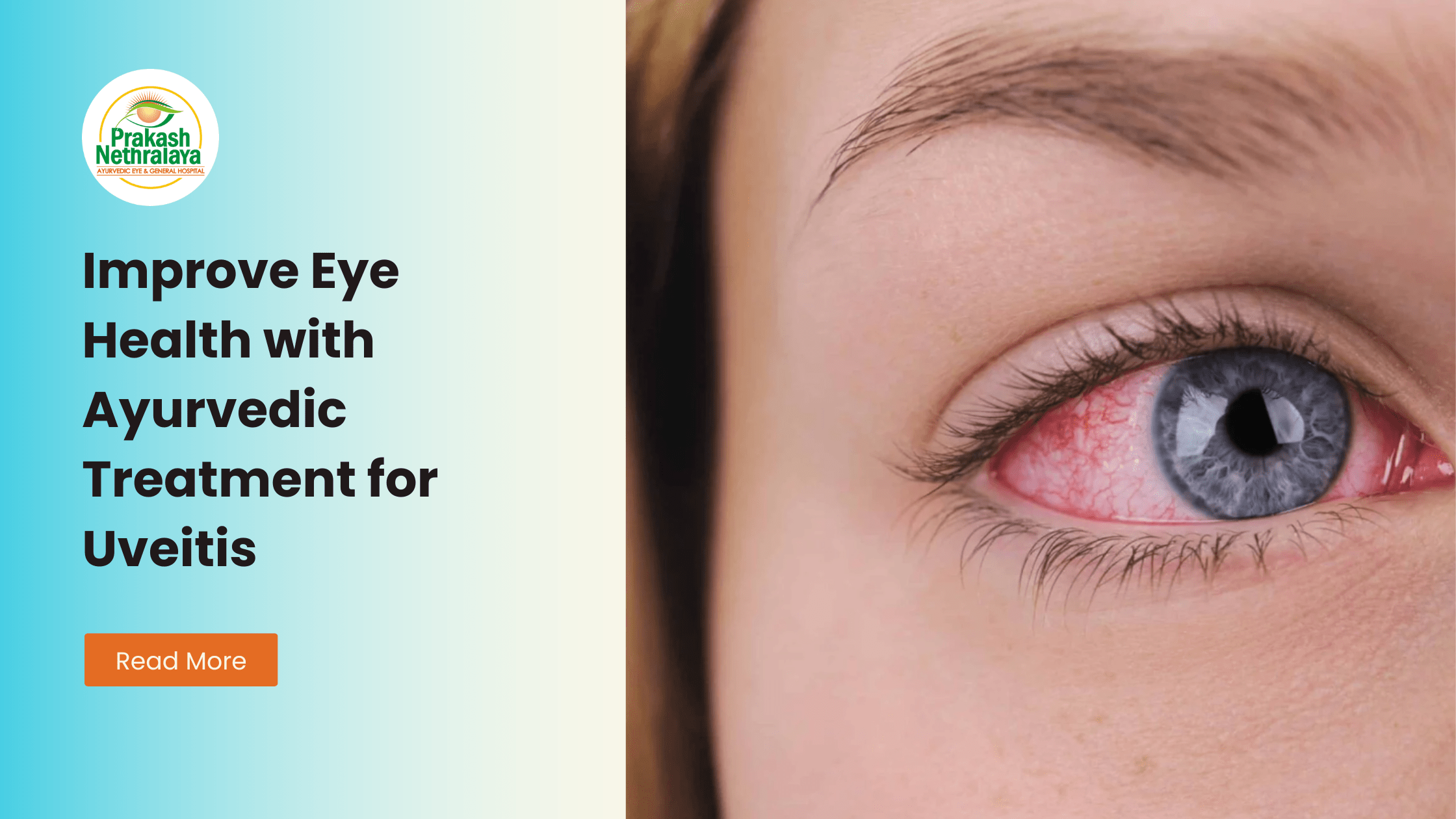 ayurvedic treatment for uveitis