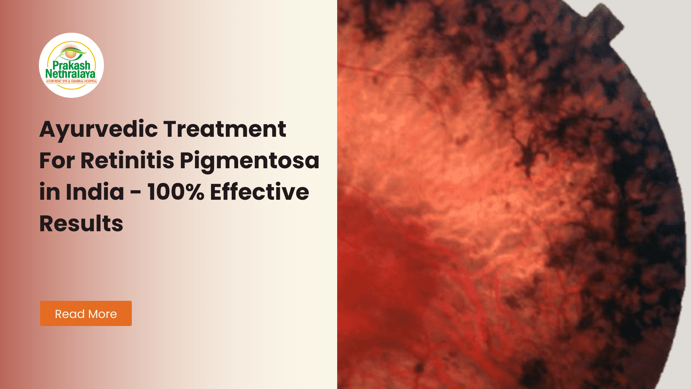 Retinitis Pigmentosa treatment in ayurveda