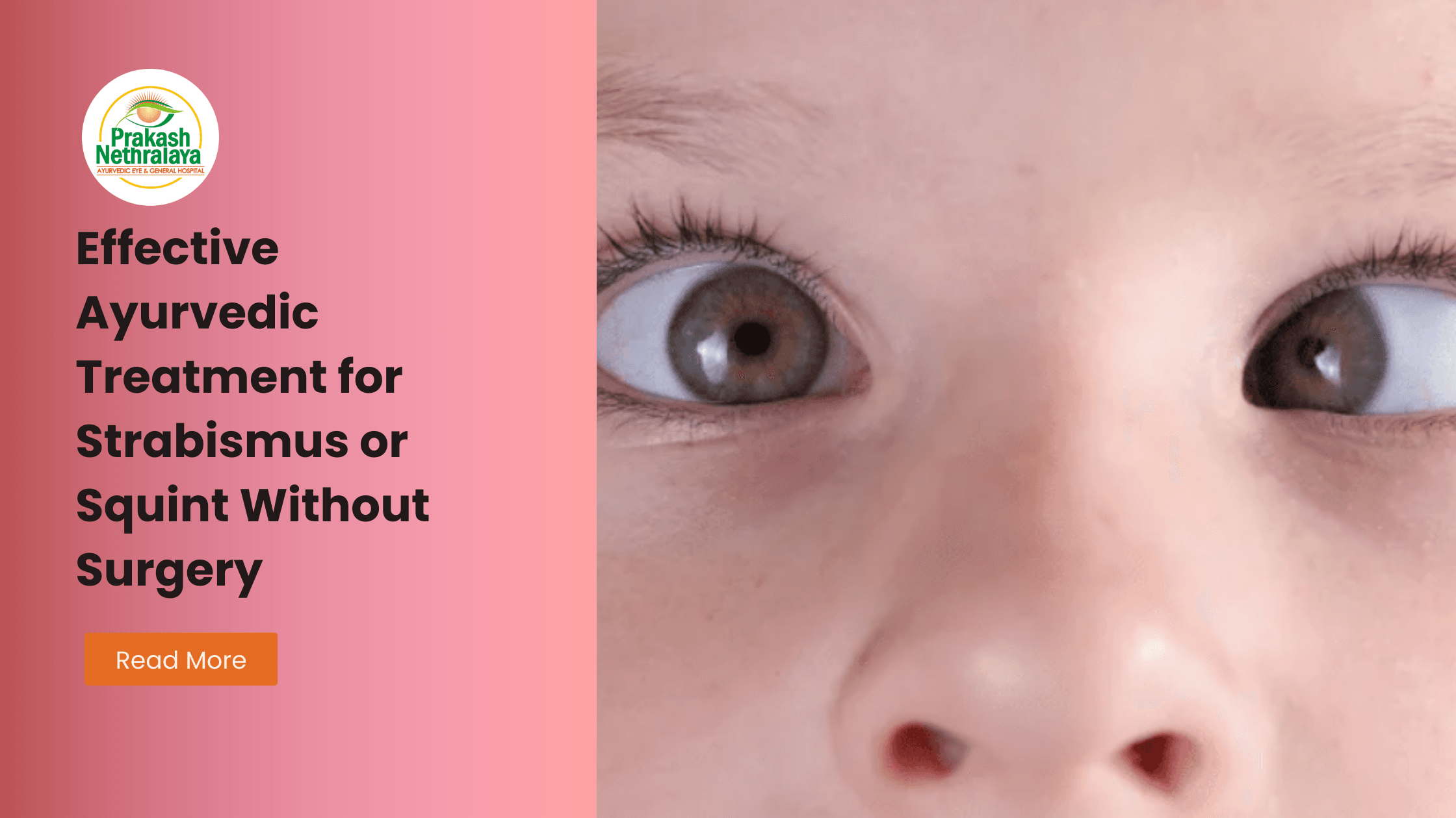 Strabismus treatment for ayurveda